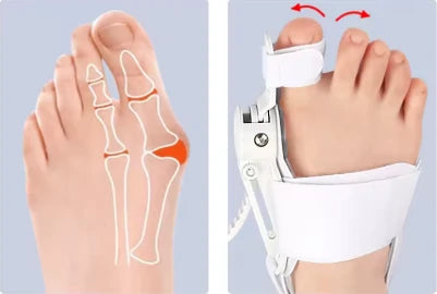 OrthoAlign™ Clinical Bunion Relief System